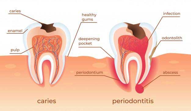 Gum Disease and It's Causes - Drs. Leaman, Setnicar & Piacsek