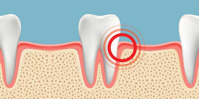 article what causes painful gums heroUpdated