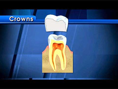 Diagram of dental crown